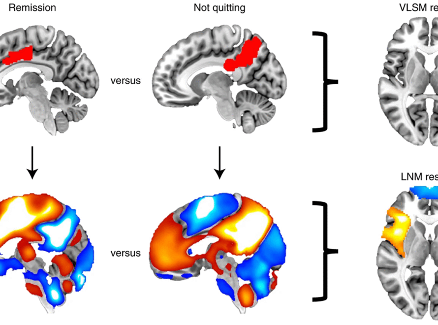 brain damage from addiction
